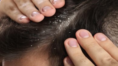 Relief from dandruff: Home remedies by Ayurvedic expert Dr. Gayatri Devi